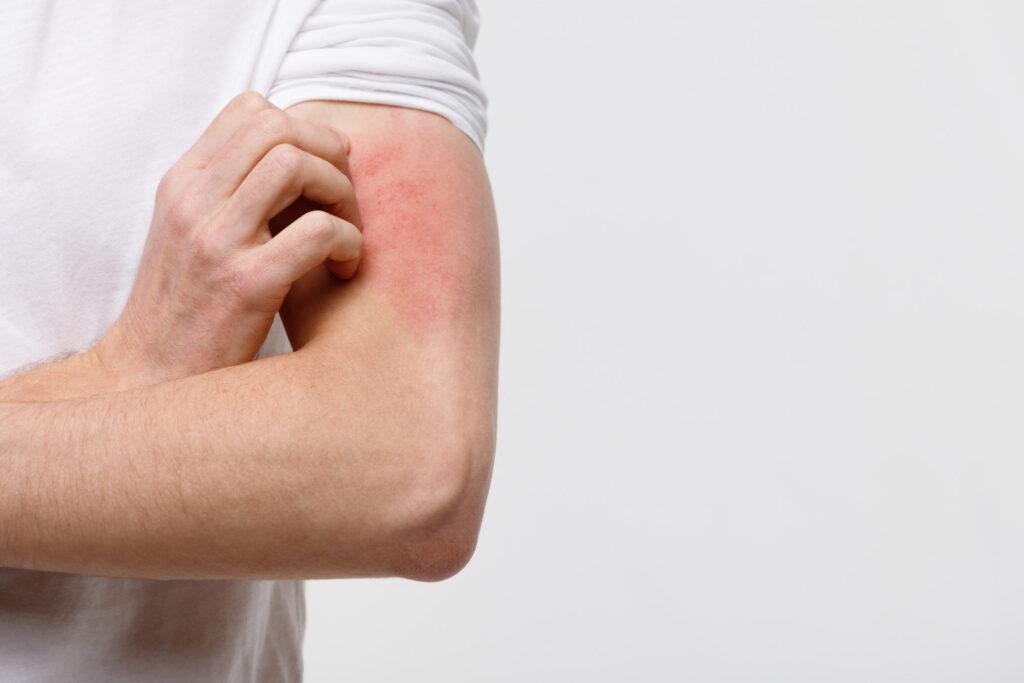 Алергічні висипи на шкірі